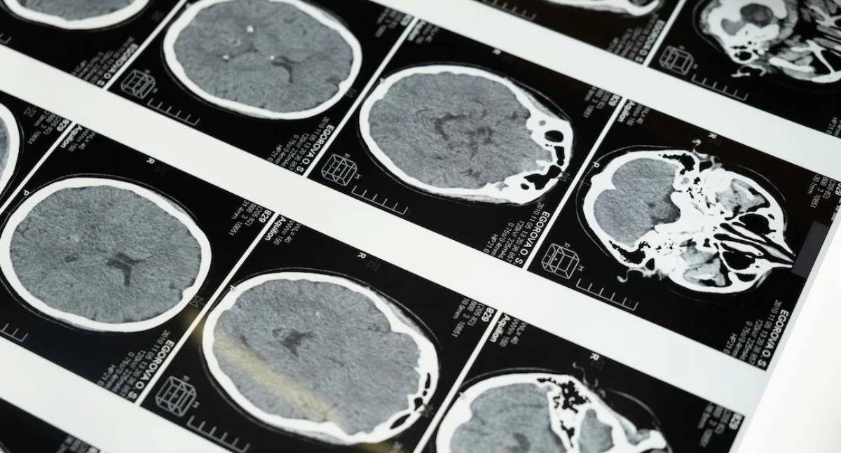 Nowa metoda badania węchu i wzroku daje nadzieję na wcześniejszą diagnozę choroby Parkinsona