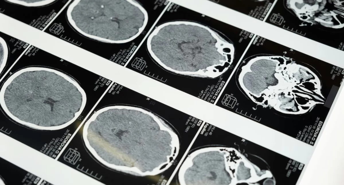 Nowy model AI pozwala diagnozować nowotwory mózgu bez ryzykownych biopsji