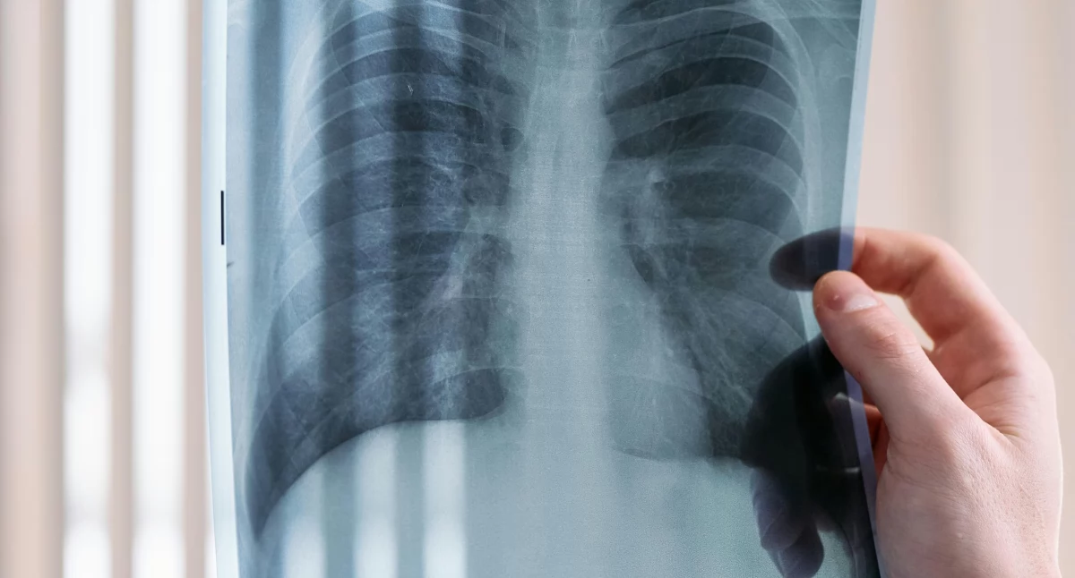 Rak płuca staje się w Polsce niemal epidemią. Eksperci: 