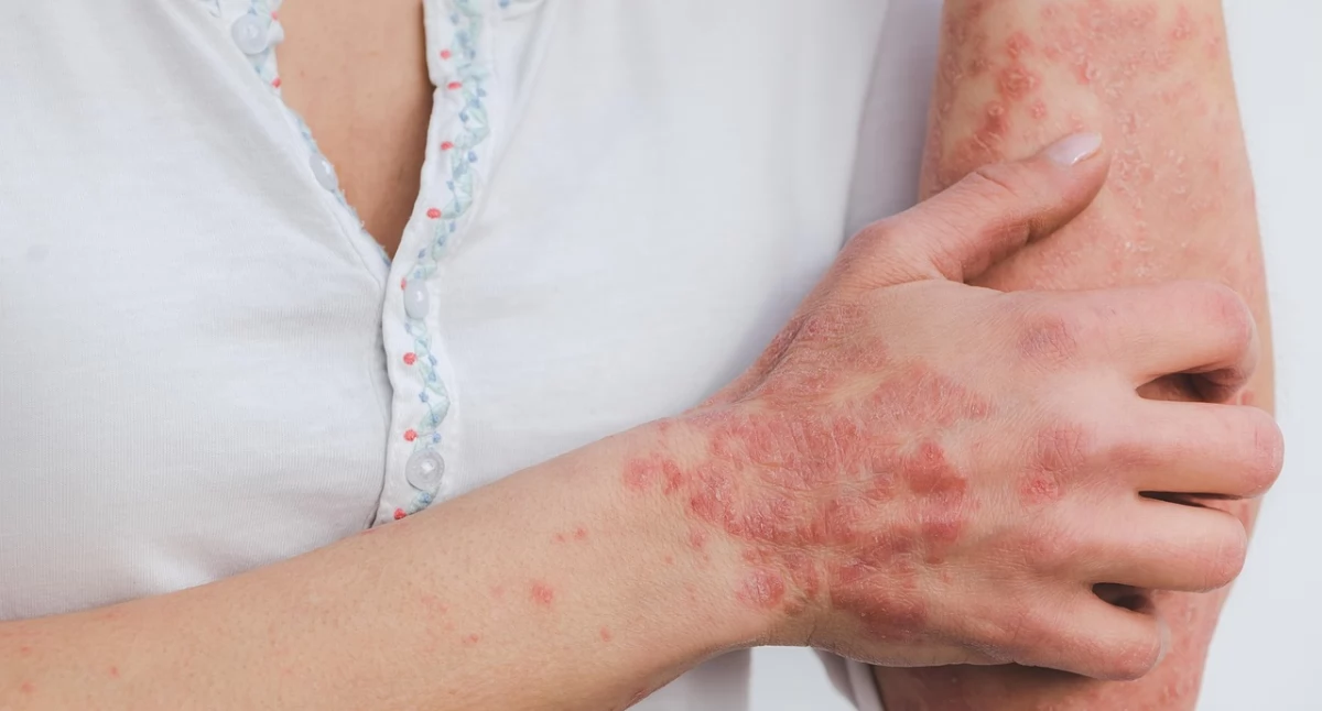 Wyniszczająca i bolesna choroba skóry – rzadka, a jednak coraz częstsza? Diagnoza przychodzi po latach cierpienia