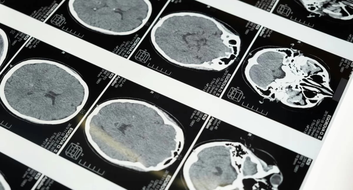 Eksperci apelują o Narodowy Plan Diagnostyki i Leczenia Chorób Mózgu