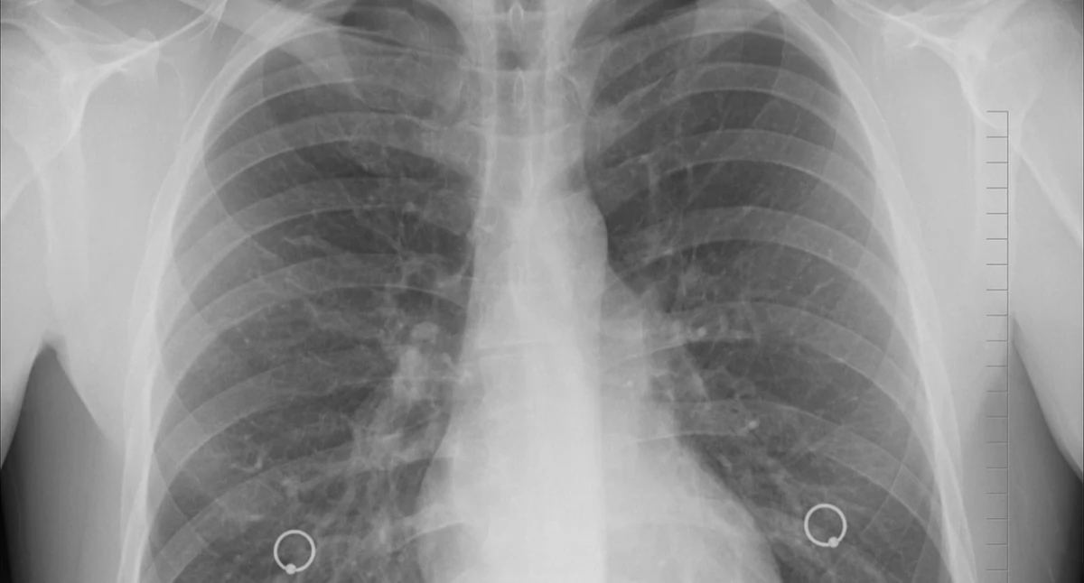 Eksperci: brak diagnostyki molekularnej odbiera chorym szansę na skuteczne leczenie raka płuca