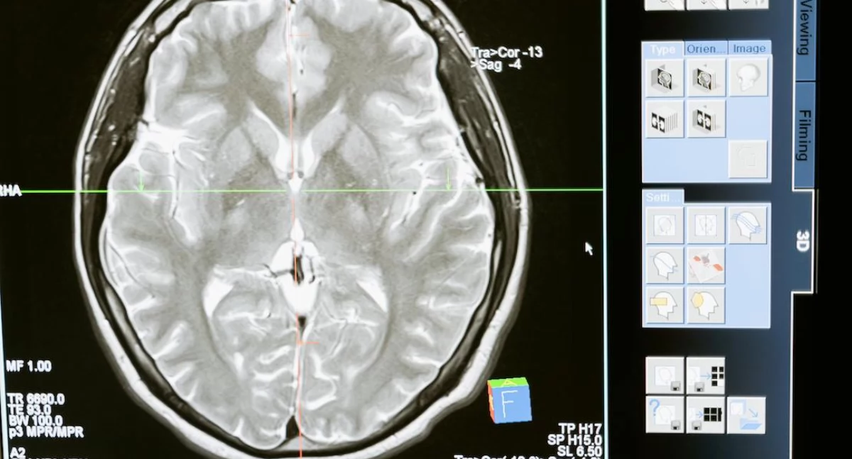 Schizofrenia może być związana z niedoborem żelaza i mieliny w mózgu – nowe dowody z badań MRI