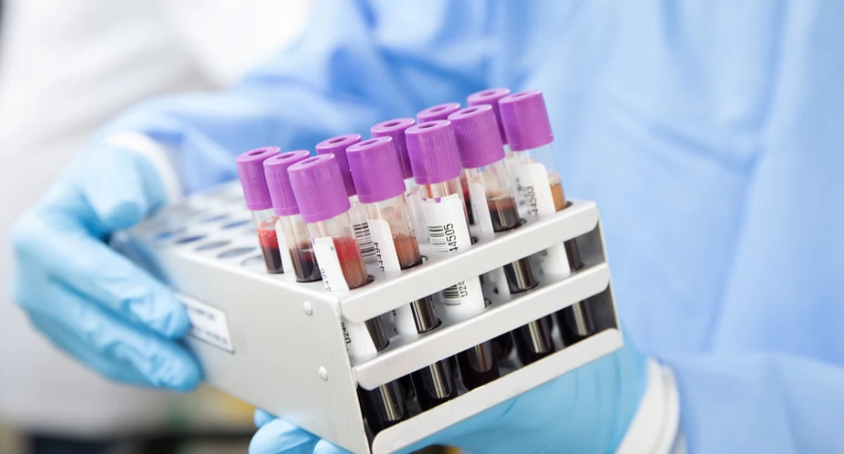 Alzheimer: prosty test krwi w średnim wieku może wykryć wczesne zmiany w mózgu