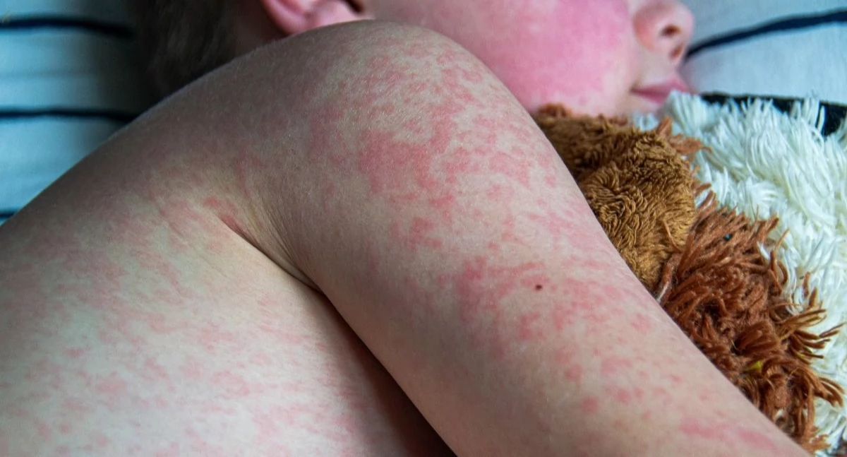 Nowe przypadki odry w Polce. Sanepid prowadzi dochodzenie epidemiologiczne