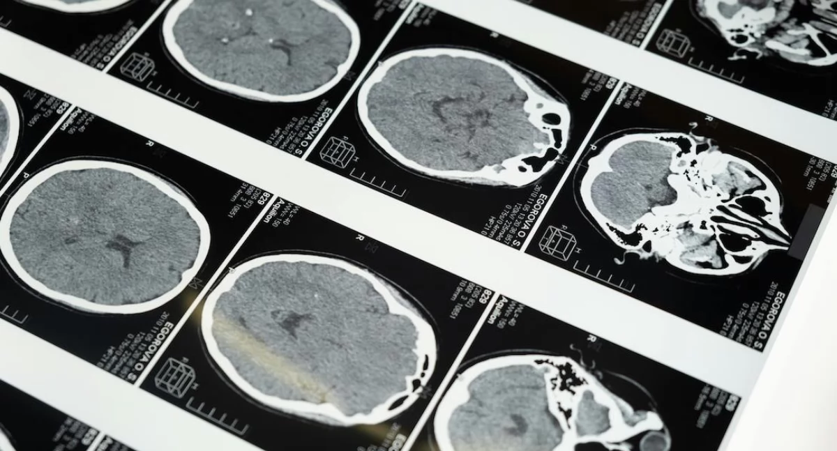 Zmodyfikowany wirus HSV-1 atakuje glejaka. Nowa terapia wydłuża przeżycie 