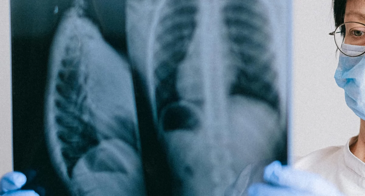 Nowa terapia skojarzona dla raka płuca z mutacją KRAS zwiększa skuteczność leczenia