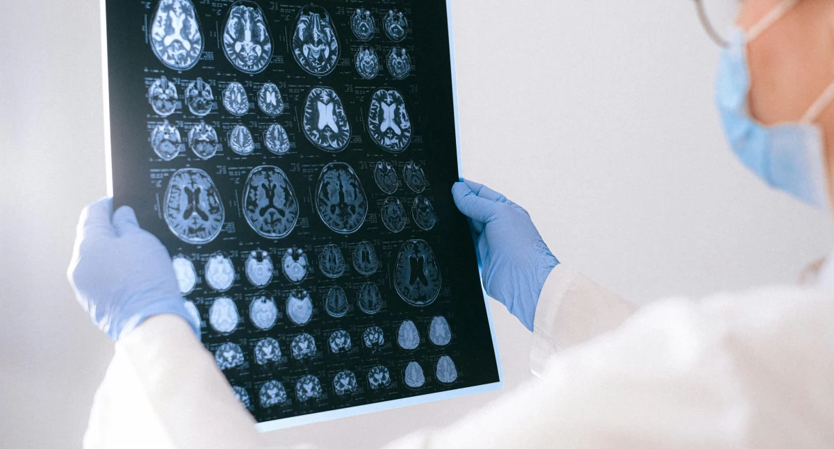 Regularne badanie tętna a ryzyko udaru mózgu. Dlaczego kontrola pulsu ma znaczenie kliniczne?