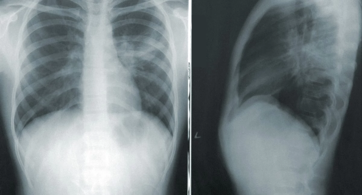 NFZ sfinansuje badania przesiewowe raka płuca. Niskodawkowa tomografia już nie tylko w pilotażu