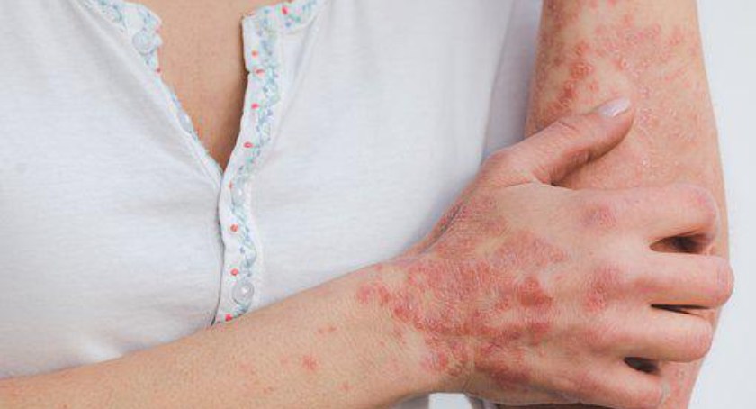 Rada Przejrzystości przy AOTMiT m.in. o lekach we wskazaniach dermatologicznych