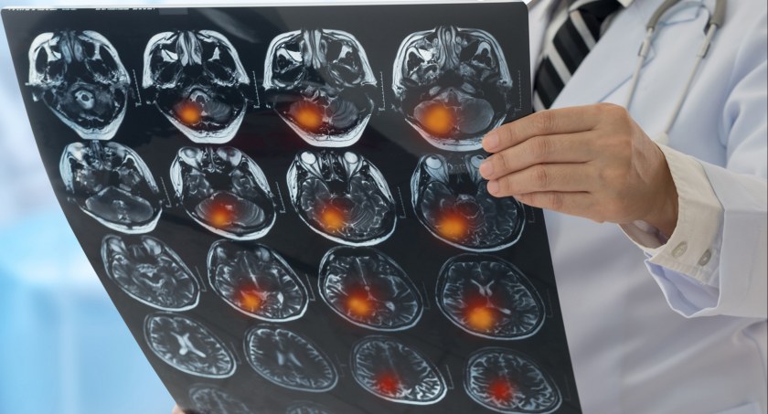 Neurolog: coraz więcej udarów u młodych ludzi