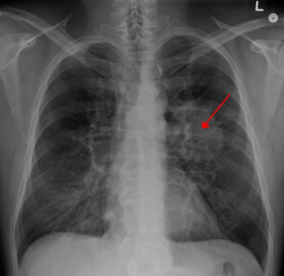W Białymstoku uruchomiono Lung Cancer Unit