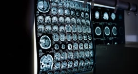 Profesor Katarzyna Kotulska-Jóźwiak: Trzeba stworzyć formalną ścieżkę przejścia pacjentów z neurologii dziecięcej do dorosłej
