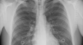 Eksperci: brak diagnostyki molekularnej odbiera chorym szansę na skuteczne leczenie raka płuca