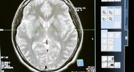 Schizofrenia może być związana z niedoborem żelaza i mieliny w mózgu – nowe dowody z badań MRI