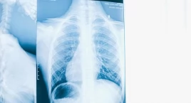 Rak płuc wciąż zabija najczęściej, choć prosta tomografia mogłaby temu zapobiec