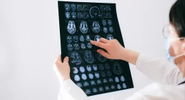 Nowe podejście do diagnozy stwardnienia rozsianego dzięki badaniom obrazowym