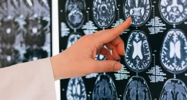 Światowy Dzień Mózgu. „Choroby neurologiczne dotyczą&hellip;