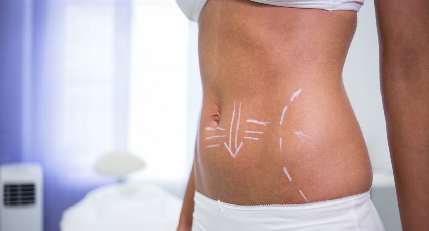 Liposukcja Laserowa Warszawa: Kompleksowe Wprowadzenie do Nowoczesnej Metody Modelowania Ciała