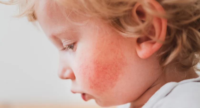 Reakcja alergiczna u dziecka – co zrobić? Pierwsza pomoc w 3 krokach