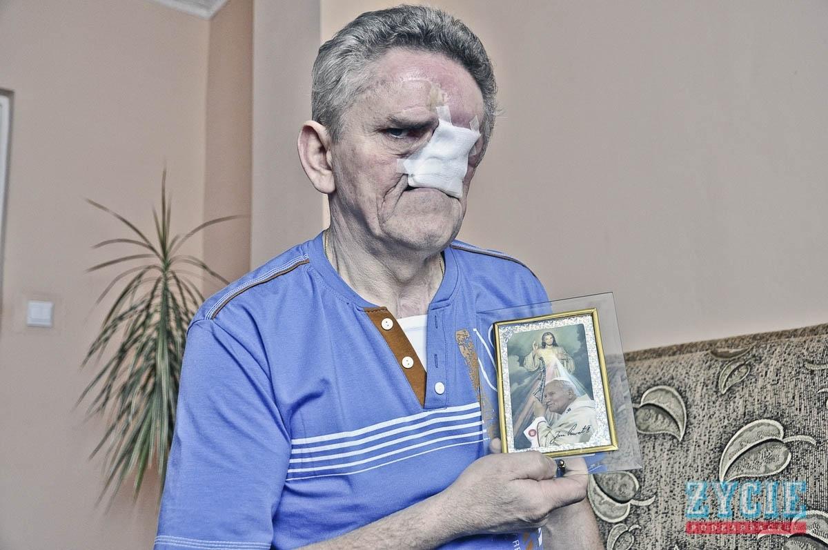 Przez nowotwór stracił pół twarzy, a jego walka ciągle trwa