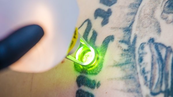 Laserowe usuwanie tatuażu