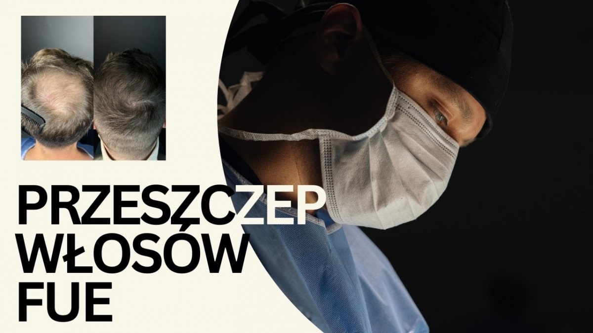 Przeszczep włosów czy mikropigmentacja – co wybrać?