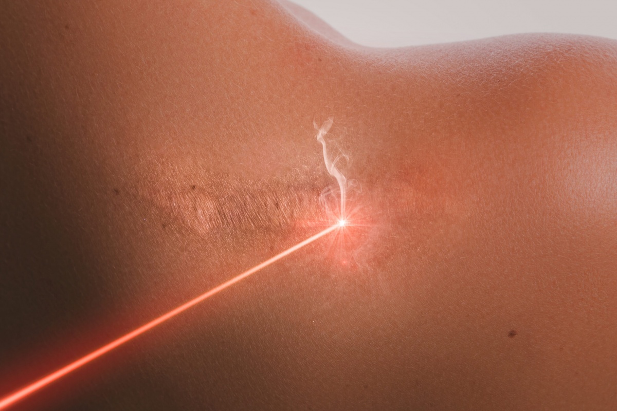 Osocze bogatopłytkowe czy laserowe usuwanie blizn? Ocena skuteczności zabiegów