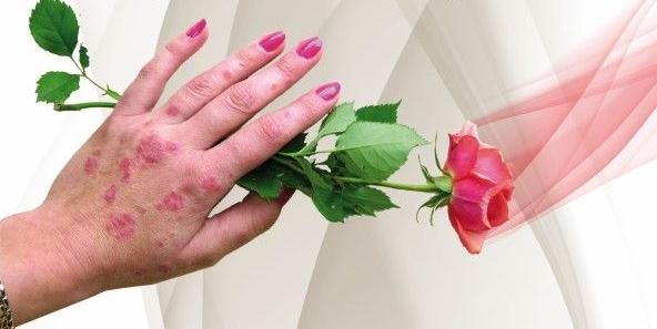 Łuszczyca nie zaraża