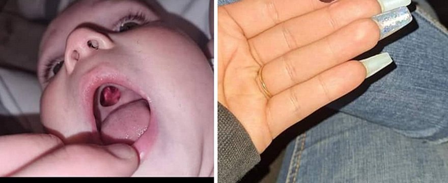 Przerażona mama odkryła dziurę w podniebieniu synka! Teraz ostrzega innych

