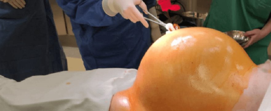 Mimo gigantycznego guza w brzuchu odwlekała wizytę u lekarza!
