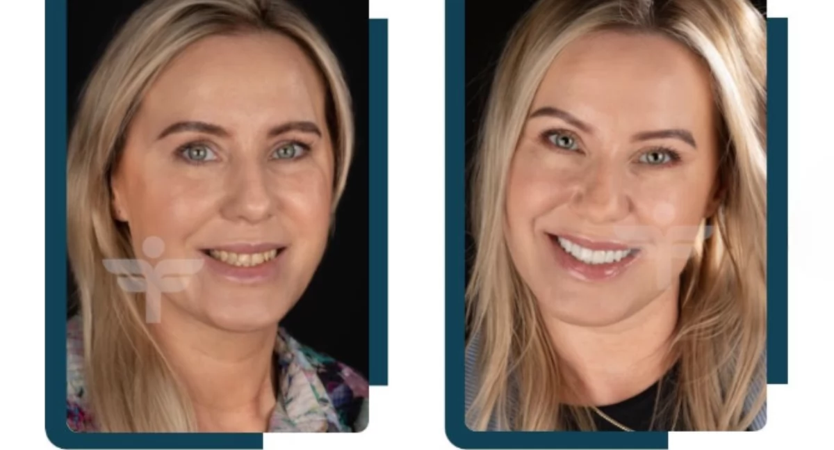 Uśmiech jak z czerwonego dywanu – co to właściwie jest Hollywood Smile?