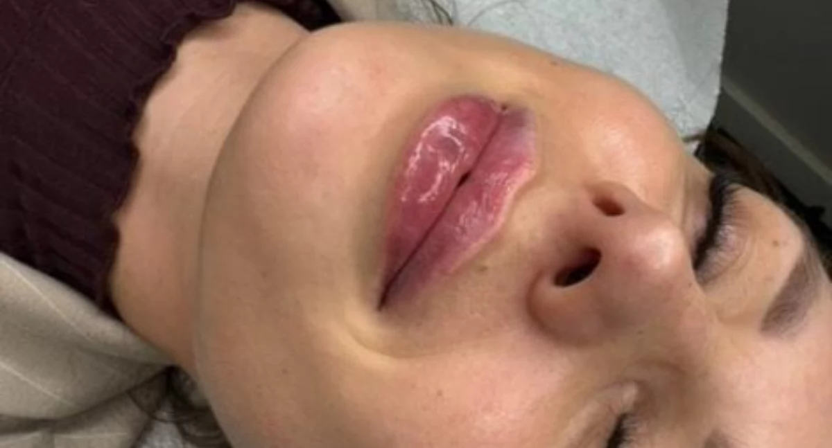 Modelowanie i powiększanie ust kwasem hialuronowym w Toruniu