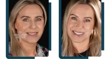 Uśmiech jak z czerwonego dywanu – co to właściwie jest Hollywood Smile?